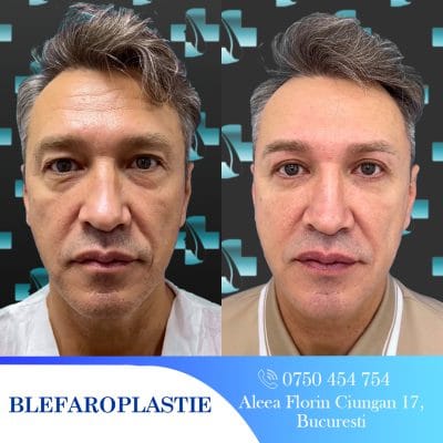 Rezultate blefaroplastie: înainte și după. Lifting facial, rejuvenare facială, chirurgie estetică ochi.
