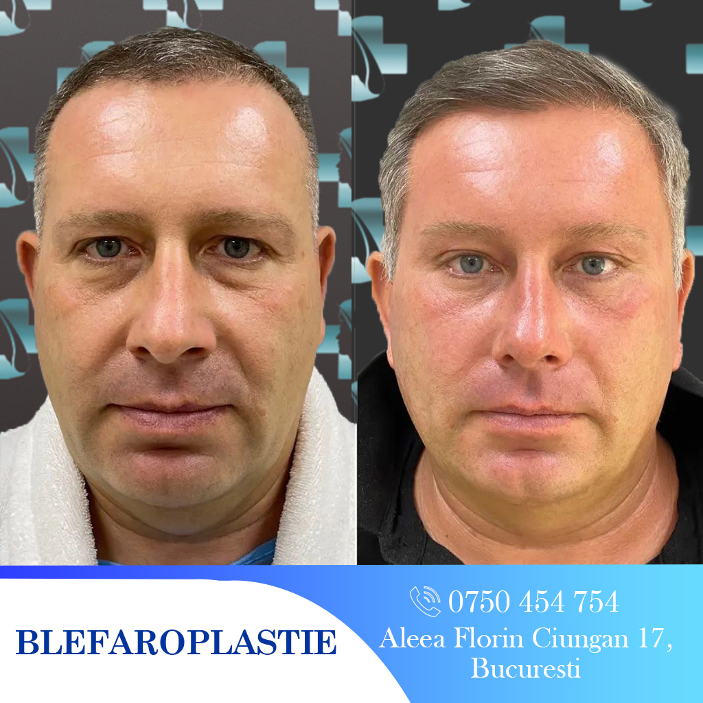 Rezultat blefaroplastie: înainte și după. Reîntinerire facială, chirurgie estetică ochi, București.