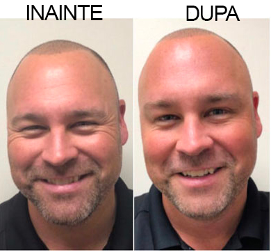 Rezultate transplant de păr: înainte și după. Bărbat zâmbitor, cu mai mult păr după tratament. Îmbunătățire aspect. Rezultate transplant de păr: înainte și după. Bărbat zâmbitor, cu mai mult păr după tratament. Îmbunătățire aspect.
