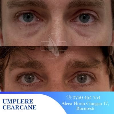 umplere cearcane pacient 5